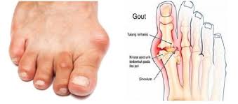 gout